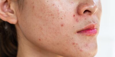 Was Dermatologen empfehlen – und was nicht