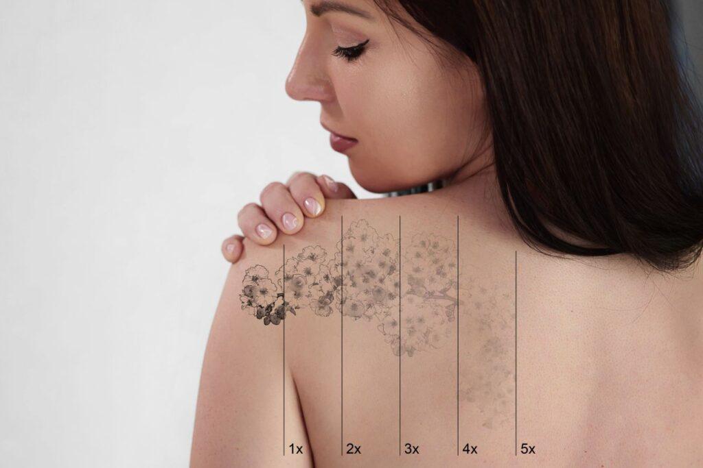 Tattooentfernung Düsseldorf: Verlauf einer Entfernung in 5 Schritten auf der Schulter einer Frau mit floraler Tätowierung