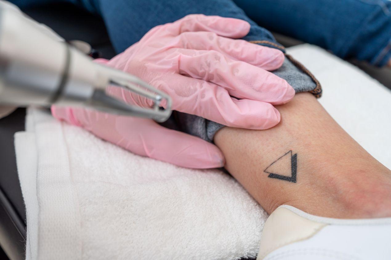 Tattooentfernung Düsseldorf: Präzise Entfernung eines kleinen Tattoos am Knöchel mit medizinischem Lasergerät